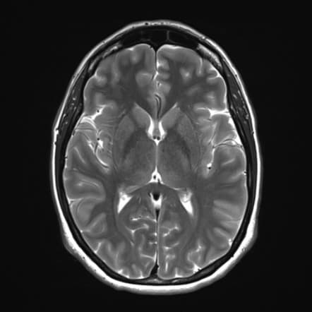 MRI Sample 4